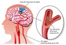Chất chuyển hóa có liên quan đến nguy cơ đột quỵ