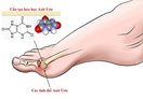 Xử trí tăng acid uric máu