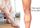Nổi gân xanh ngoằn ngoèo dưới da rất có thể bạn đã mắc bệnh nguy hiểm này